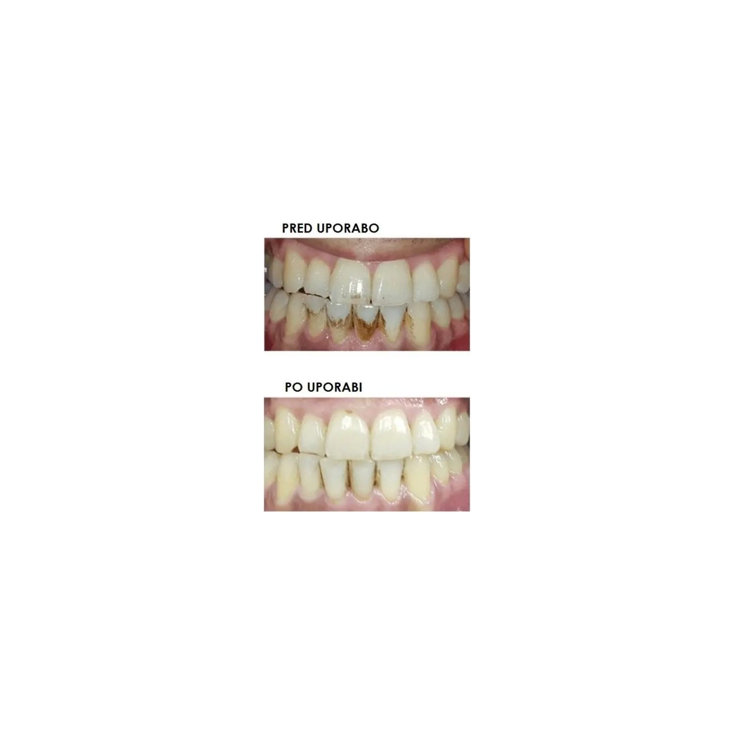 Silkn ToothWave TW1PE3001